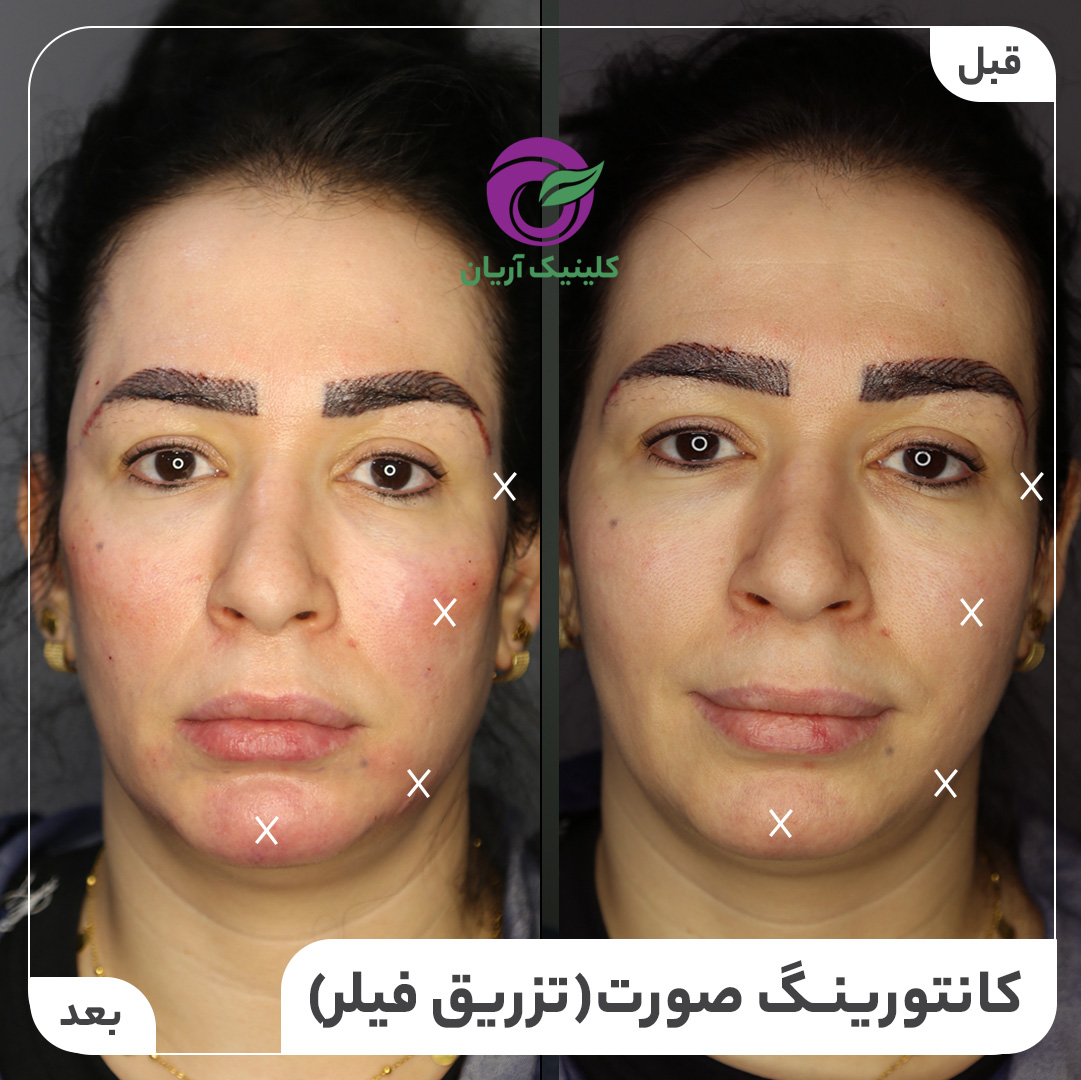 تصاویر قبل و بعد از تزریق ژل